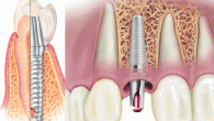 Имплантация зубов – комфорт, удобство и новое качество жизни